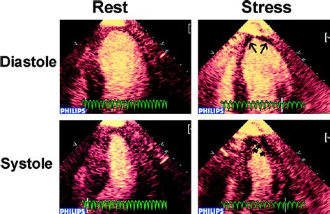 stress echocardiogram results|Angina pectoris: value of stress echocardiography .